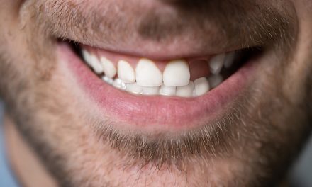 Nedostatak zuba – estetski problem ili zdravstveni rizik?